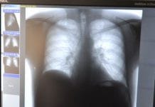 За 5 лет в Амурской области почти в два раза снижена заболеваемость туберкулёзом